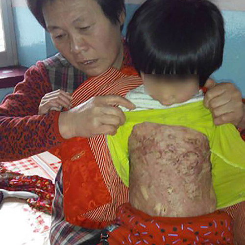 4歲女童王妤心不慎被爐上的開水嚴(yán)重燙傷，受傷面積達(dá)40%